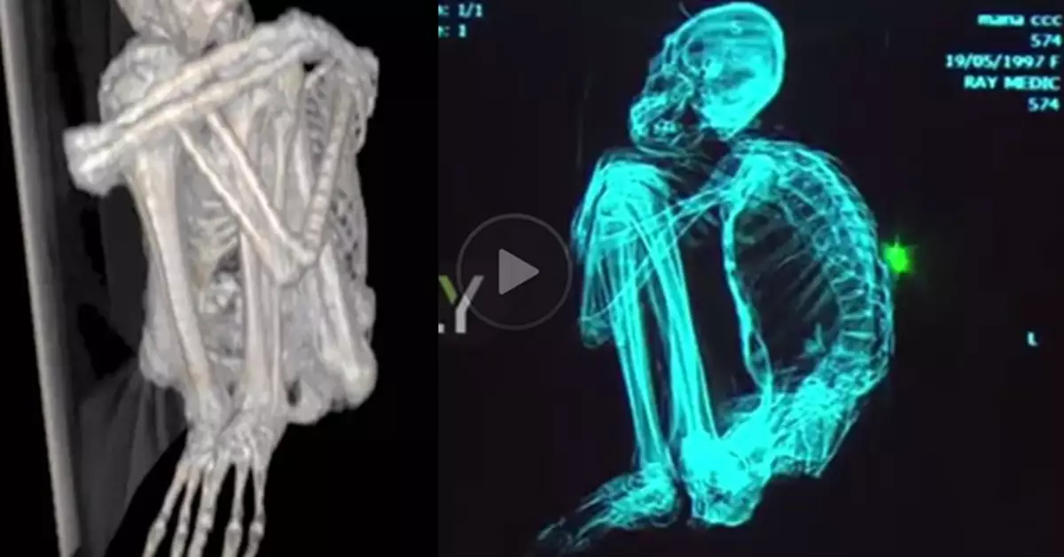 Hoax or not? 3-fingered, 3-toed mummies dated thousand years ago are unearthed in Peru