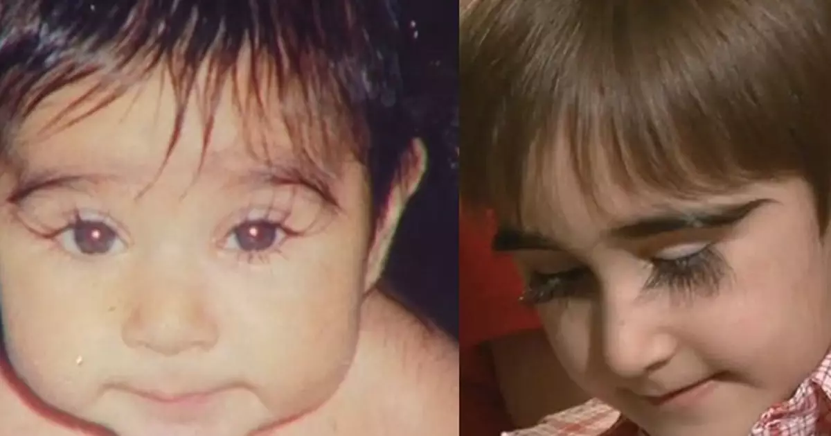 11-year-old boy’s eyelashes grow surprisingly up to 4.3 cm when he was born 