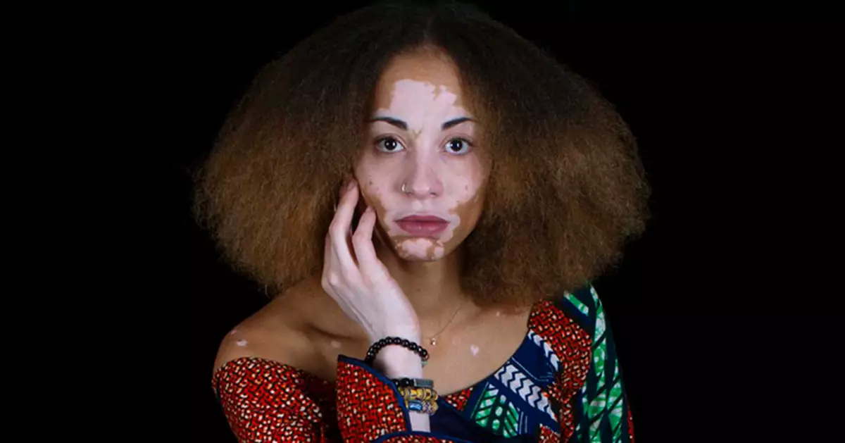 Artist embraces condition that turned her dark skin white by tattooing around the marks it left