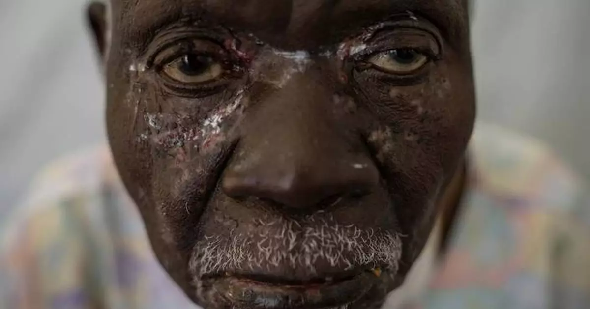 A photographer captures the mpox health crisis in Africa in a closeup