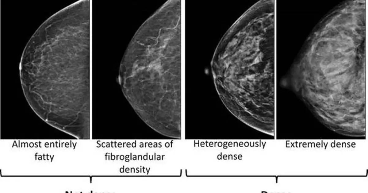 Dense breasts can make it harder to spot cancer on a mammogram