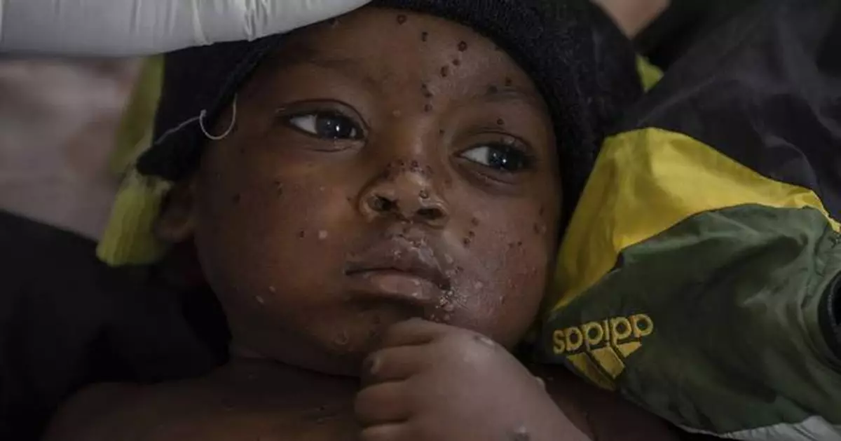 Mpox cases in Congo may be stabilizing. Experts say more vaccines are needed to stamp out virus