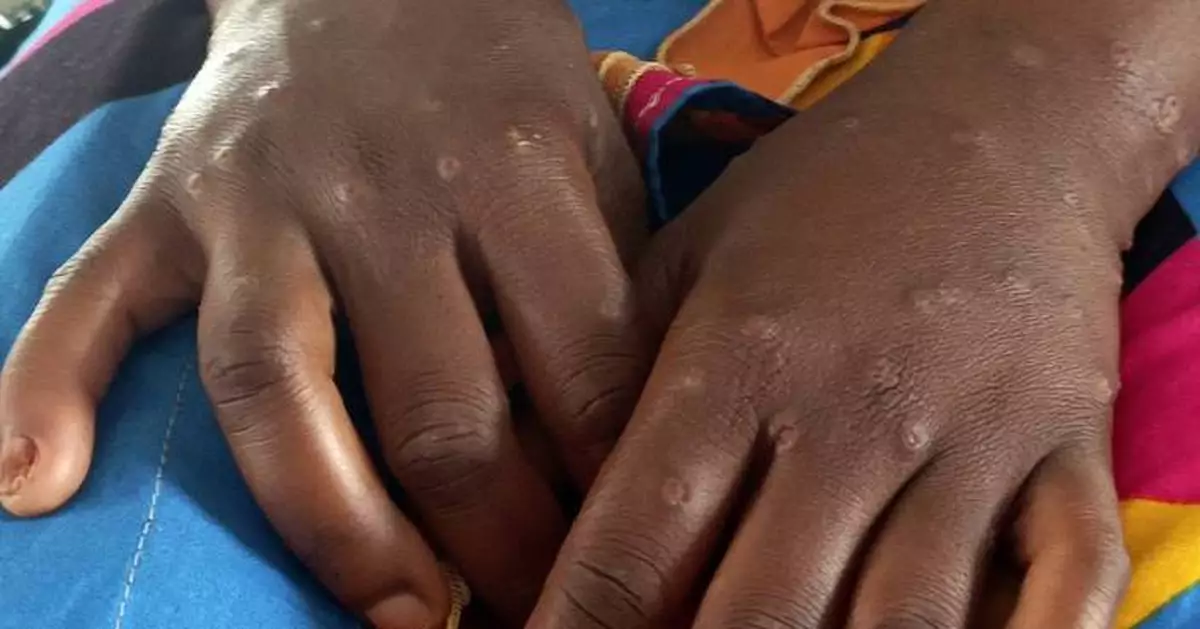 Congo faces setback in mpox response after Rwanda-backed rebels advance in the east