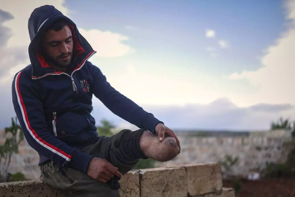 Shepherd Jalal Ma'rouf, 22, shows the stump of the limb he lost to a landmine while herding sheep in farmland recently recaptured from regime forces, at his home in Deir Sunbul village, south of Idlib, Wednesday, April 9, 2025. (AP Photo/Ghaith Alsayed)