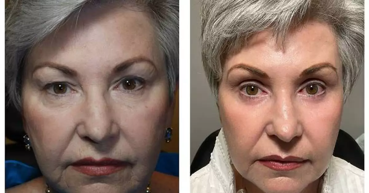 Dr. Adam Scheiner Named “Best Surgical Facial Rejuvenation” at AMWC 2025 in Monaco