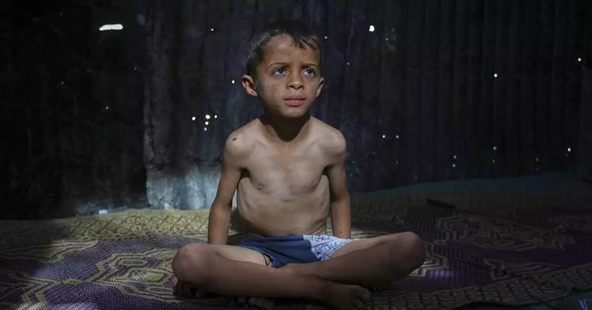 AP PHOTOS: Many in Gaza face malnutrition and hunger as blockade enters its third month