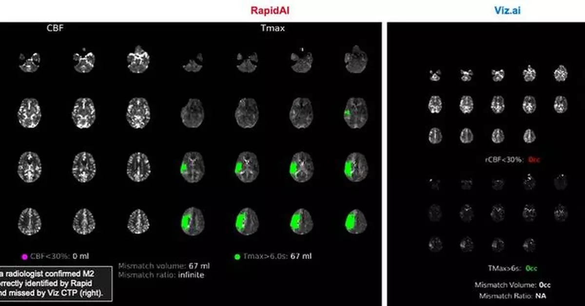 New Study Finds RapidAI Significantly Outperforms Viz.ai in Detecting Medium Vessel Occlusions in Stroke Patients