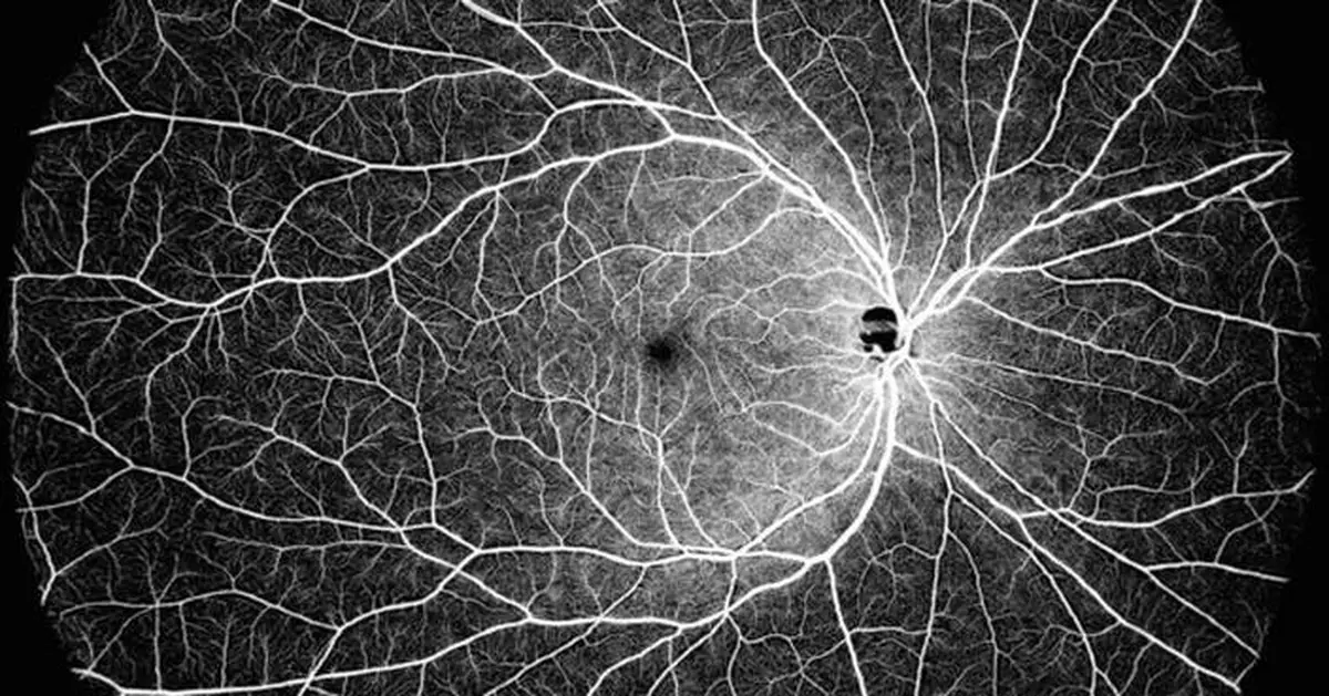 Intalight™ Receives CE Mark for Its Progressive DREAM OCT™ Swept Source Imaging