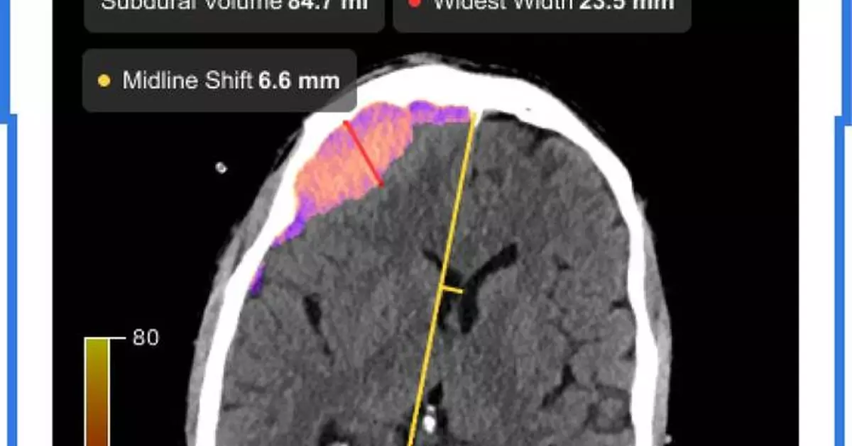 Viz.ai Receives First and Only FDA 510(k) Clearance for Subdural Measurements