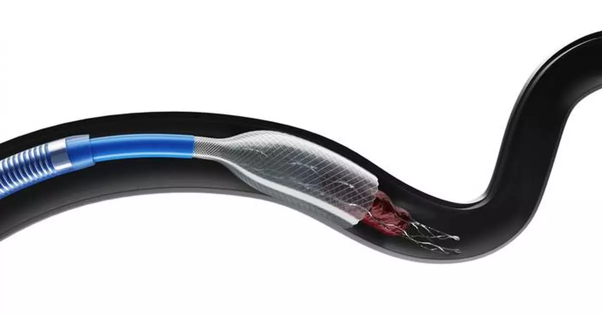 ANACONDA Biomed Receives CE Mark for Its ANA5 Funnel Catheter to Treat Ischemic Stroke