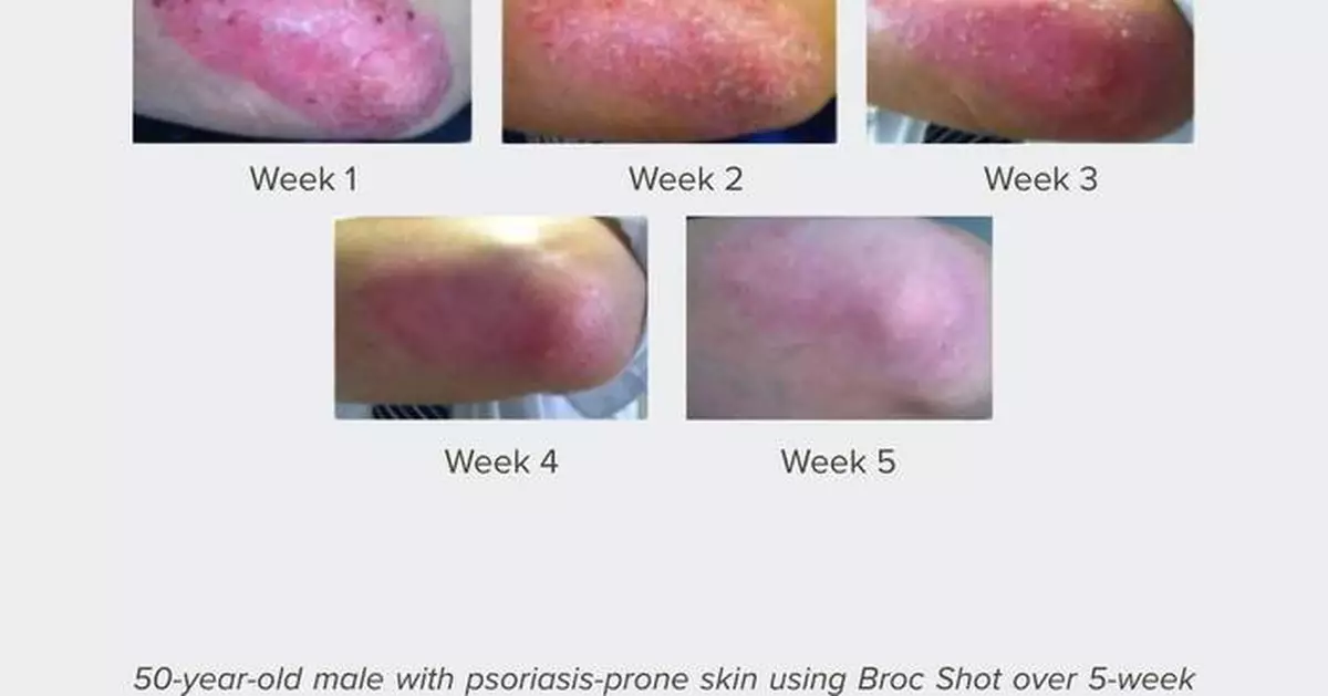 Broc Shot Becomes the First Supplement to Receive the Seal of Recognition From the National Psoriasis Foundation