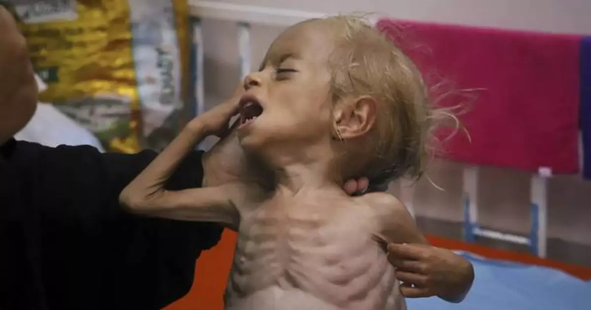 Malnourished kids arrive daily at a Gaza hospital as Netanyahu denies hunger