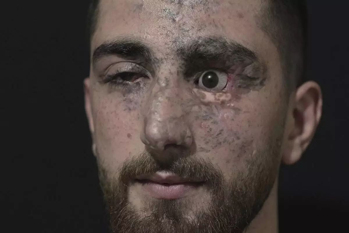 Mahdi Sheri, 23, who was wounded in the pagers attack carried out by Israel on September 17, 2024, poses for a photograph in Beirut's southern suburb of Burj al-Barajneh, Lebanon, Monday, May 12, 2025. (AP Photo/Hassan Ammar)