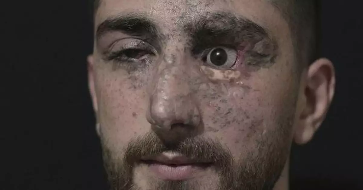 PHOTO ESSAY: Portraits of survivors of Israel's pager attack on Hezbollah last year