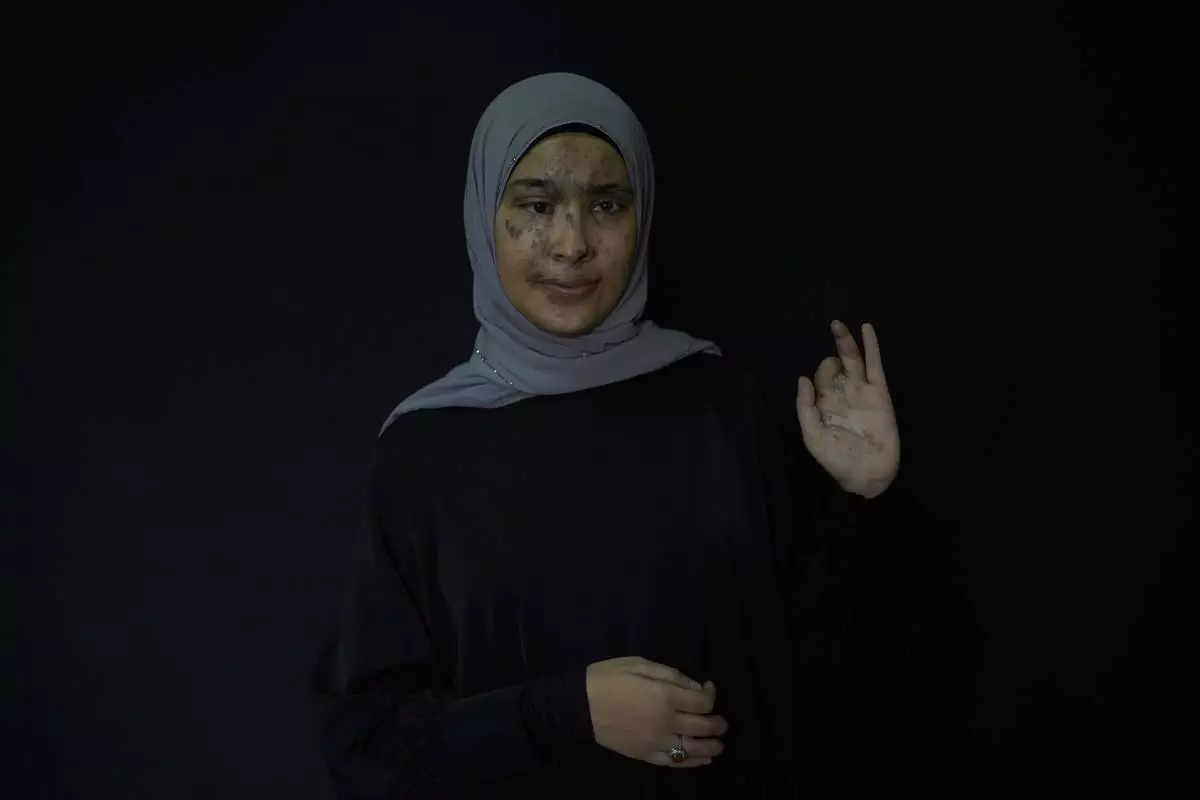 Sarah Jaffal, 21, who was wounded in the pagers attack carried out by Israel on September 17, 2024, shows her wounded hand as she poses for a photograph in the southern village of Bazourieh, Lebanon, Thursday, May 1, 2025. (AP Photo/Hassan Ammar)