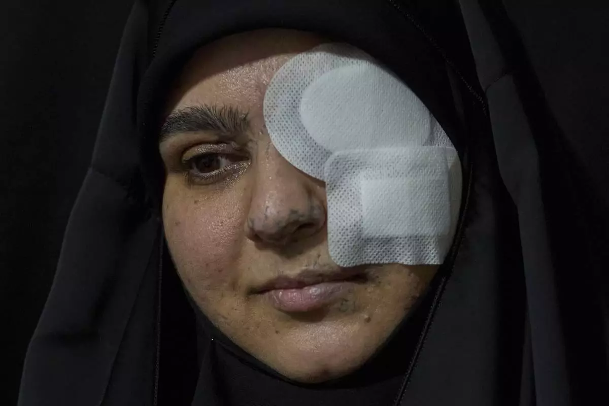 Zeinab Mestrah, 26, who was wounded in the pagers attack carried out by Israel on September 17, 2024, poses for a photograph in the Dahiyeh suburb of Beirut, Lebanon, Friday, April 25, 2025. (AP Photo/Hassan Ammar)