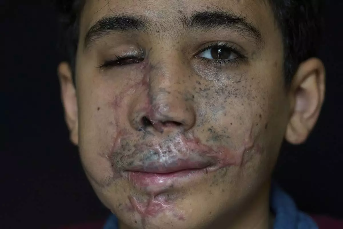 Hussein Dheini, 12, who was wounded in the pagers attack carried out by Israel on September 17, 2024, poses for a photograph in the southern village of Teir Debba, Lebanon, Thursday, May 1, 2025. (AP Photo/Hassan Ammar)