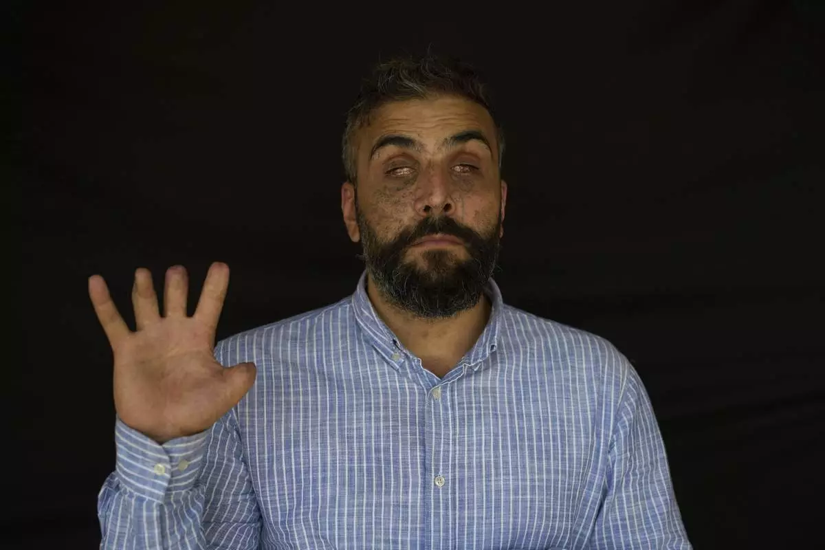 Mustafa Choeib, 35, who was wounded in the pagers attack carried out by Israel on September 17, 2024, shows his wounded hand as he poses for a photograph in the southern village of Borj Rahhal, Lebanon, Monday, April 28, 2025. (AP Photo/Hassan Ammar)