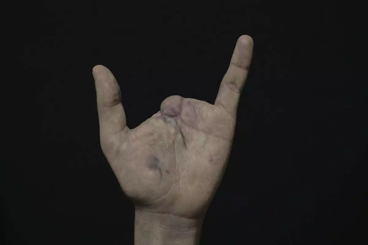 Mahdi Sheri, 23, who was wounded in the pagers attack carried out by Israel on September 17, 2024, shows his wounded hand as he poses for a photograph in Beirut's southern suburb of Burj al-Barajneh, Lebanon, Monday, May 12, 2025. (AP Photo/Hassan Ammar)