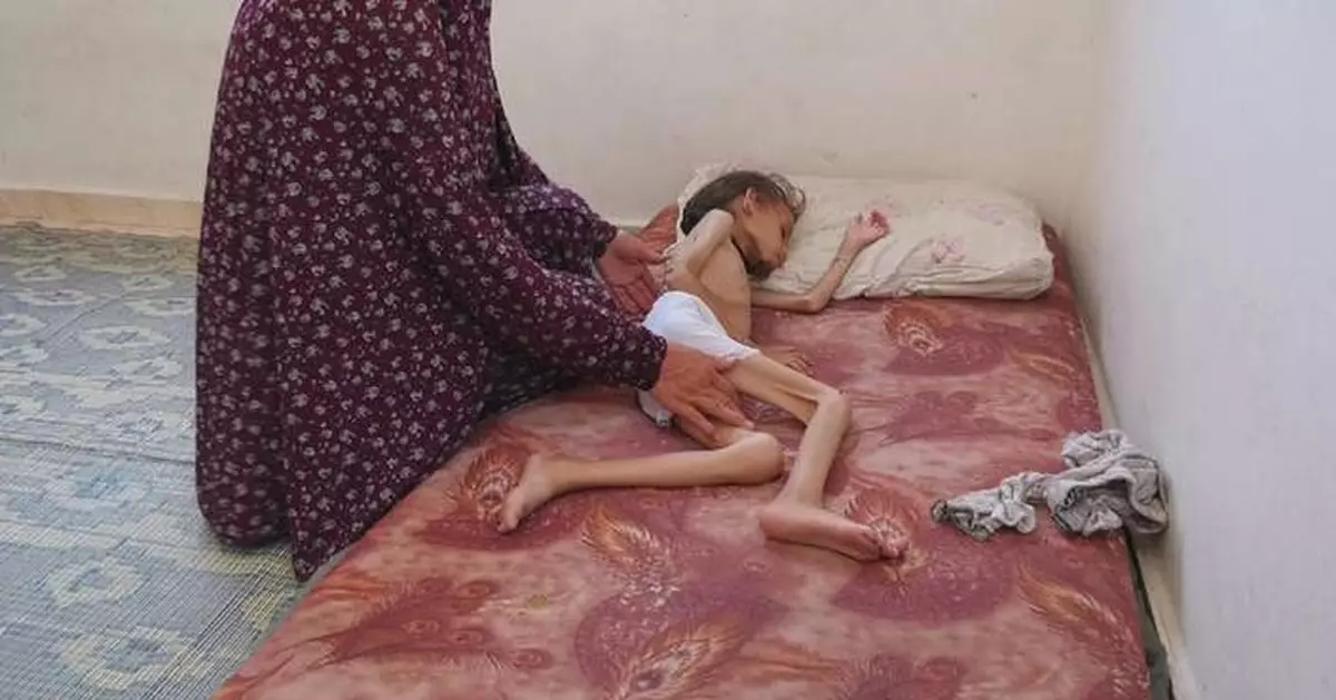 Starving children in desperate need of aids as famine unfolds in Gaza