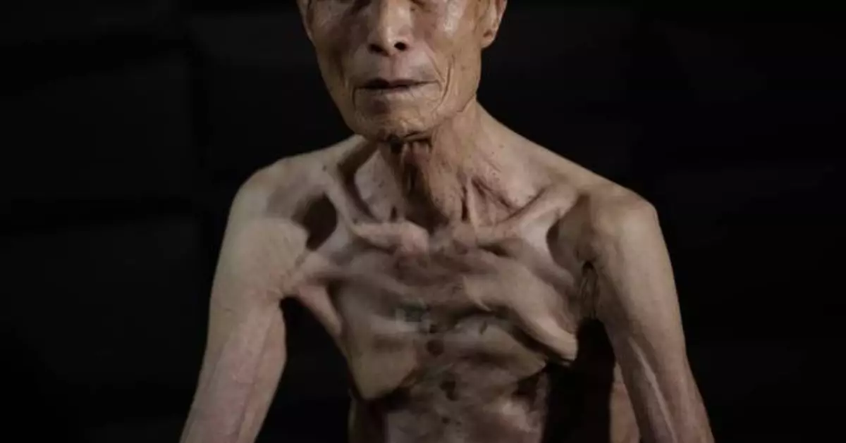 Powerful AP photos show the scars of a survivor of the Nagasaki atomic bombing