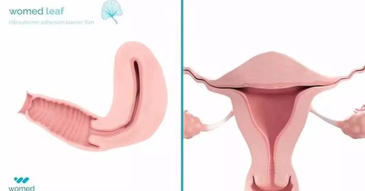 US FDA Approves First Medical Device For Women With Asherman Syndrome