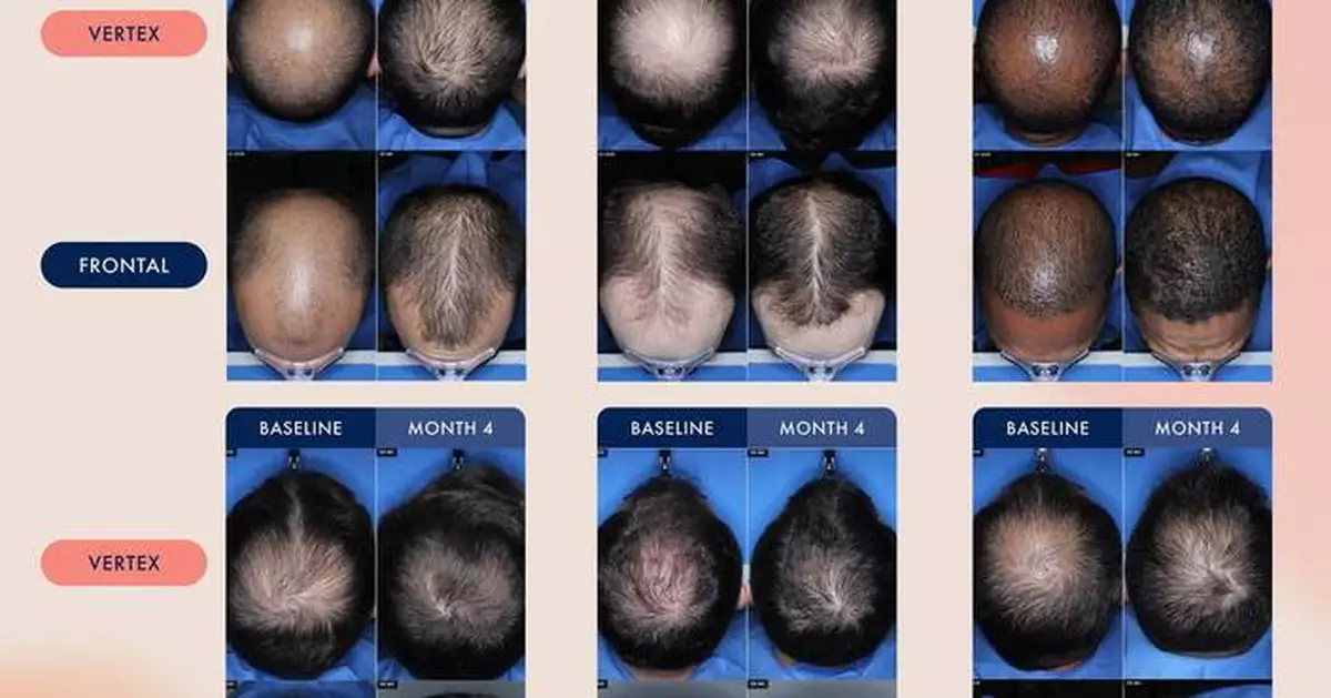 Veradermics Announces Oversubscribed $150 Million Series C Financing to Advance VDPHL01 Through Multiple Phase 3 Trials as Potentially the First Non-Hormonal Oral Therapeutic for Hair Regrowth in Women and Men