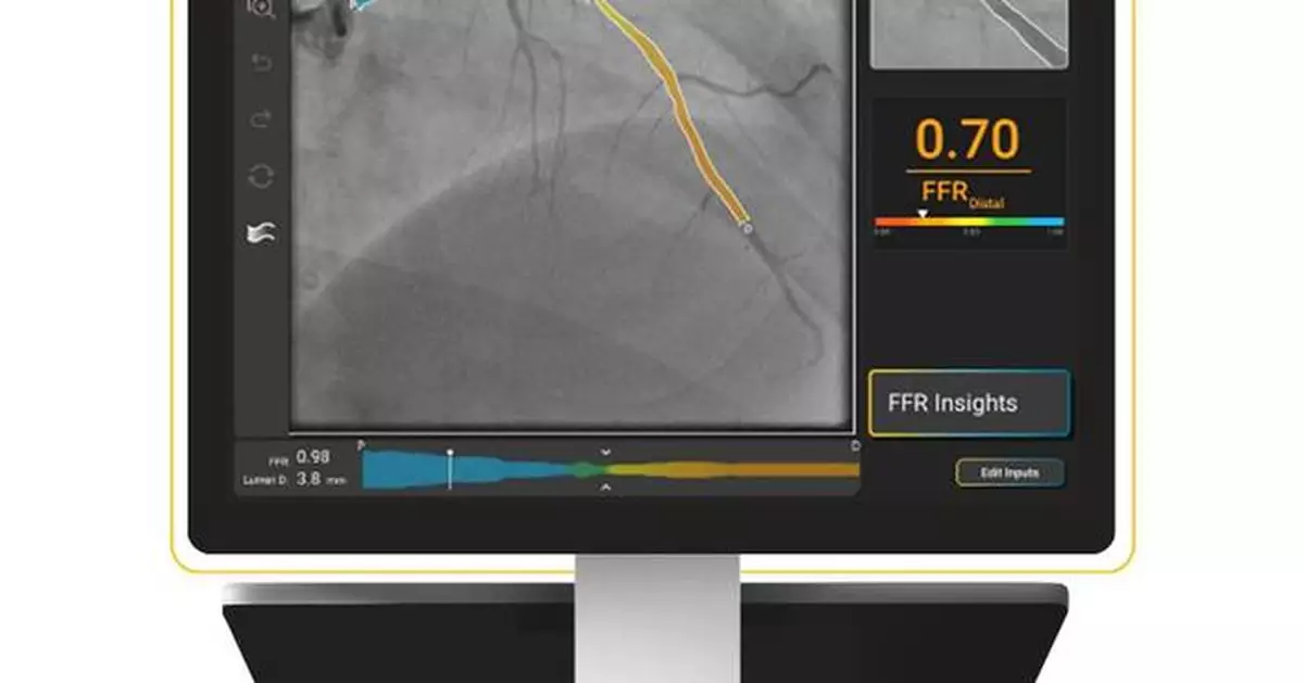 SpectraWAVE Receives 510(k) Clearance for X1™-FFR, an AI-enabled, Wire-Free, Drug-Free, Single Angiogram Physiology Solution