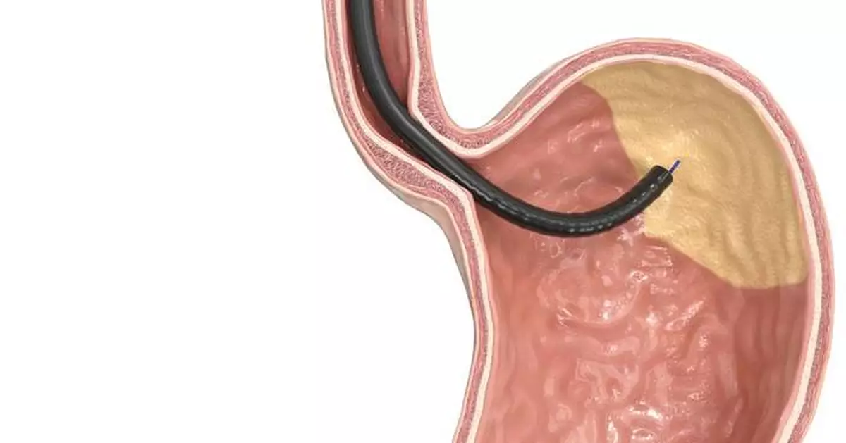 GMA with MOVIVA®: setting new standards in endoscopic bariatric treatment
