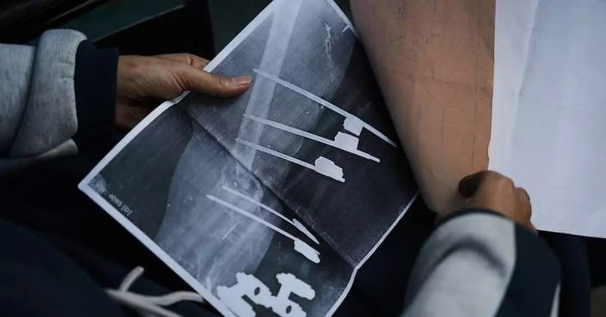 A bullet shattered her knee. Now a Gaza teen's chances of walking depend on Rafah border crossing