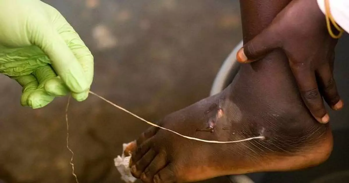World creeps closer to eradicating human Guinea worm cases, with just 10 last year: Carter Center