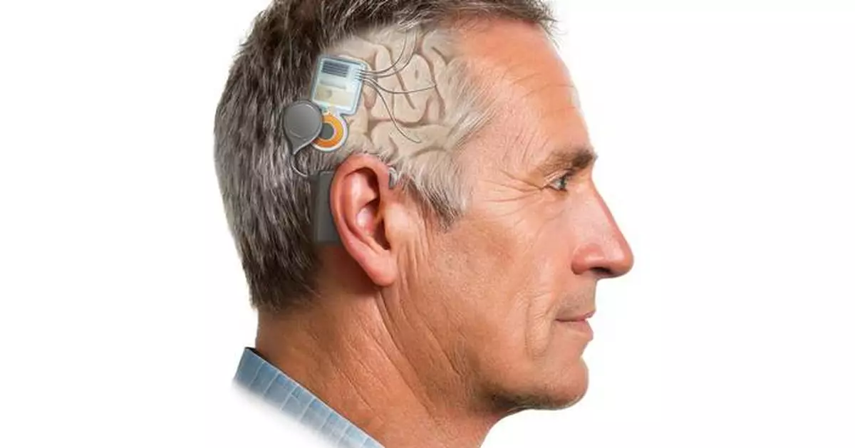 Nia Therapeutics Publishes Peer-Reviewed Validation of a 60-Channel Brain Implant for Closed-Loop Neurostimulation