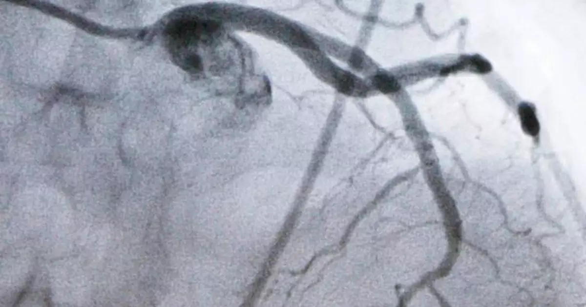 Experimental cholesterol-lowering pill may offer new option for millions