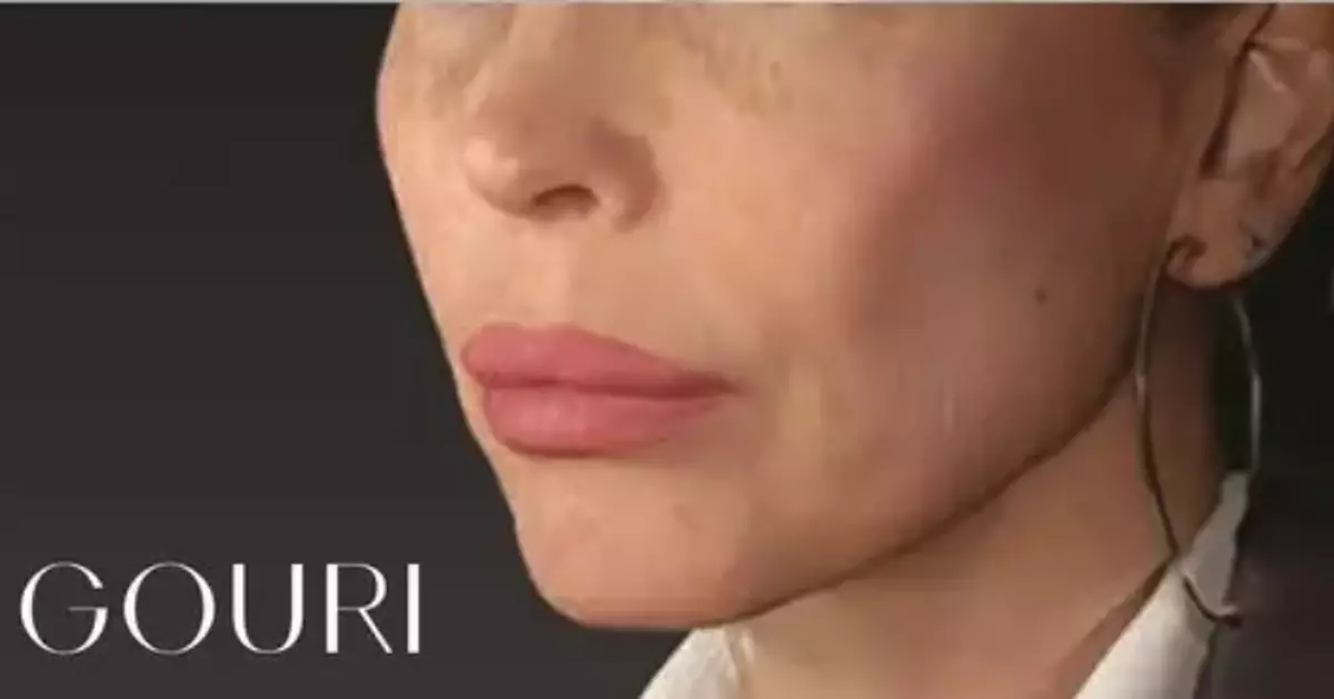 Global Aesthetic Trends Evolve Toward 'Anti-Sagging': The Expansion of the Structural Skin Laxity Improvement and Liquid Type PCL Collagen Stimulator Market