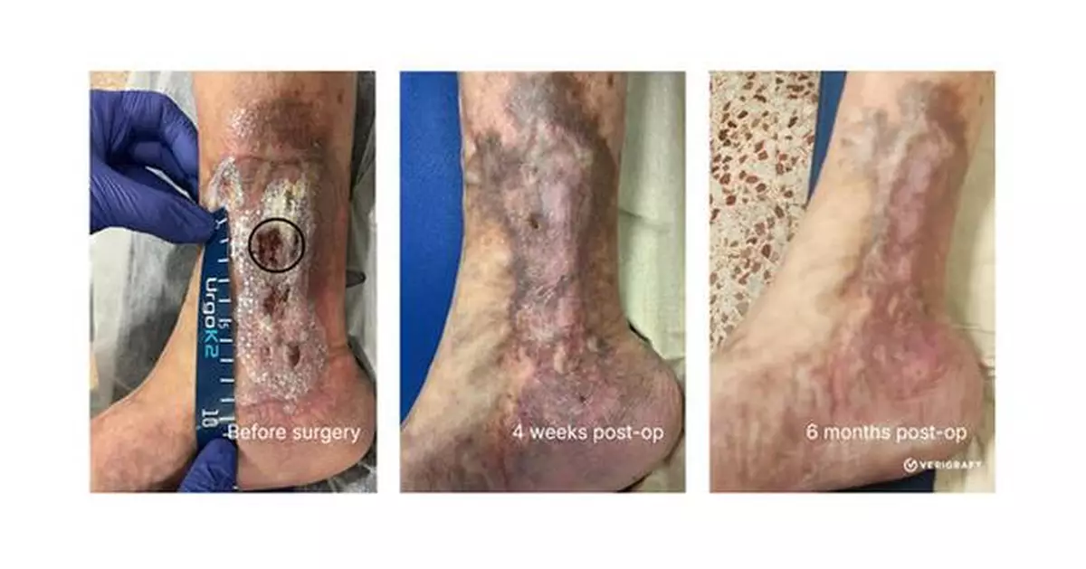 VERIGRAFT Advances First Potential Curative Treatment for CVI into Pivotal Phase II/III Trial