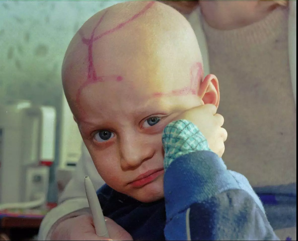FILE - Alec Zhloba sits in a children's cancer ward with markings made by doctors on his head following chemotherapy in Gomel, Belarus, March 19, 1996, nearly 10 years after the explosion and fire at the Chernobyl nuclear power plant sent radioactive clouds through Ukraine, Belarus and other parts of Europe. (AP Photo/Efrem Lukatsky, File)