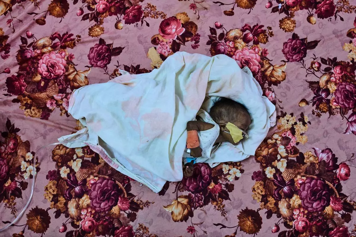 FILE - Patient Saidal Altaher, aged two months, receives treatment for malnutrition at the paediatric hospital stabilization center in Port Sudan, Sudan, Wednesday, April 15, 2026. (AP Photo/Bernat Armangue, File)
