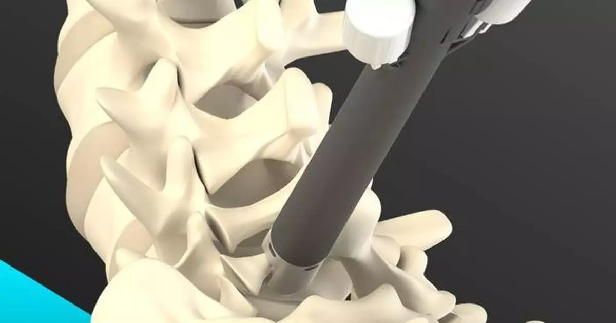 Allevion Medical™ Receives 510K Clearance for Vantage™ — A Fully Disposable Kit Featuring a Novel Approach to Spinal Decompression