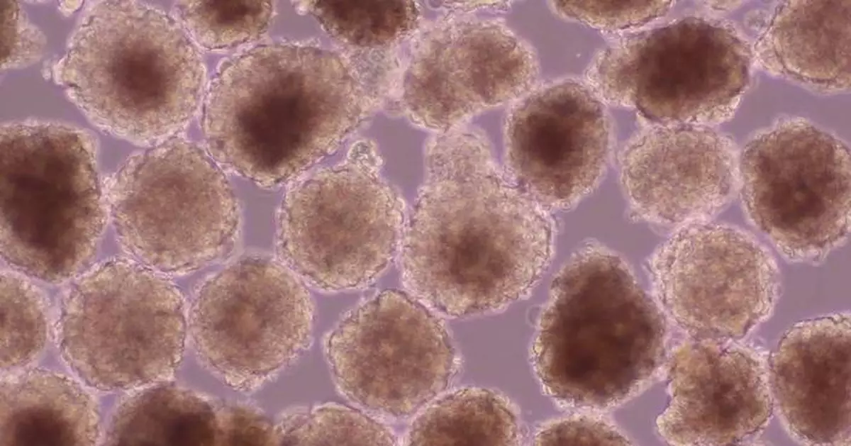 Heartseed, World's First Clinical Trial of Catheter Administration of iPSC-Derived Cardiomyocyte Spheroids: First Patient Dosed