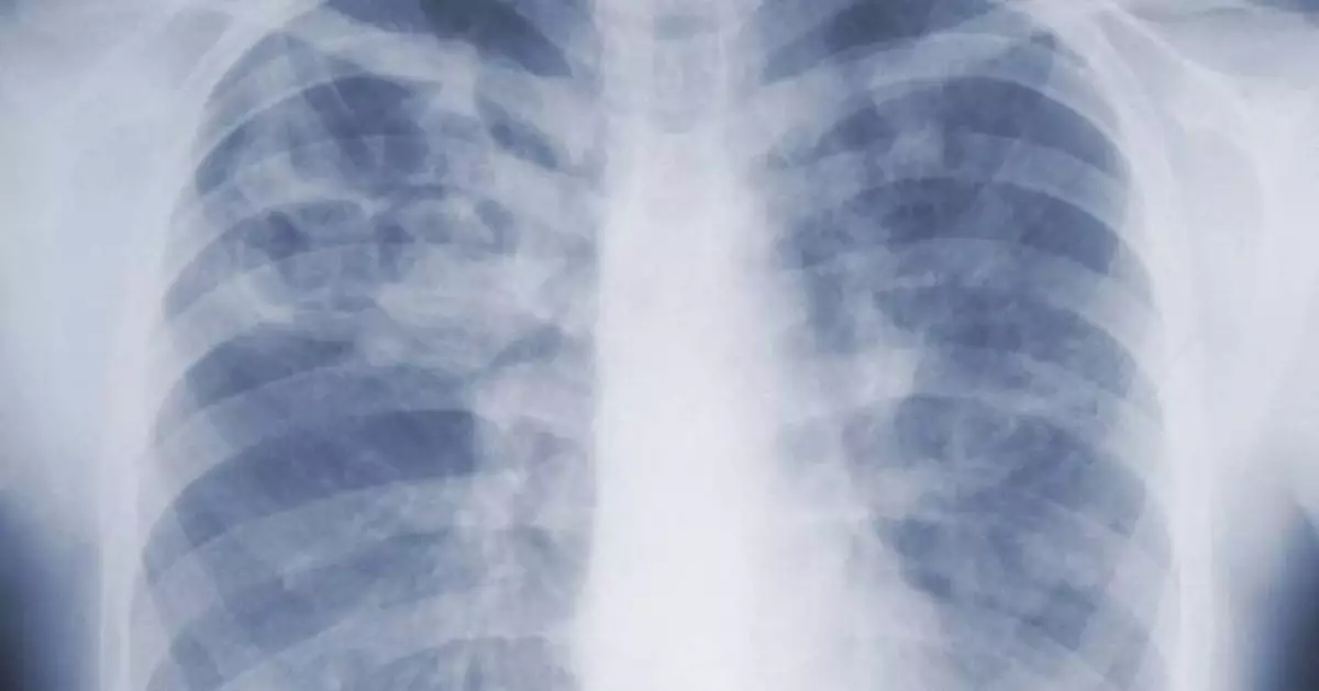 Study suggests the threat of mold-associated illnesses may be underappreciated