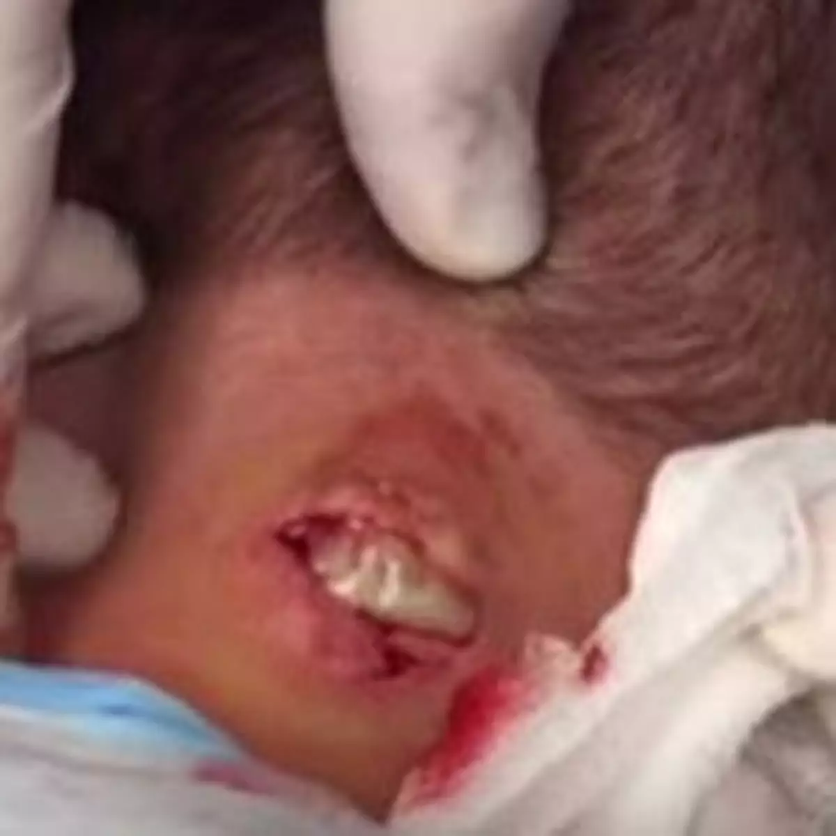 慎入！擠出十年頸瘡 膿液衝天飛