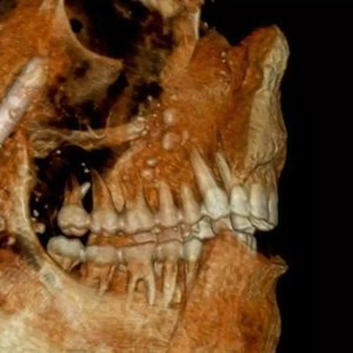 羅馬人少食糖 牙齒勁健康