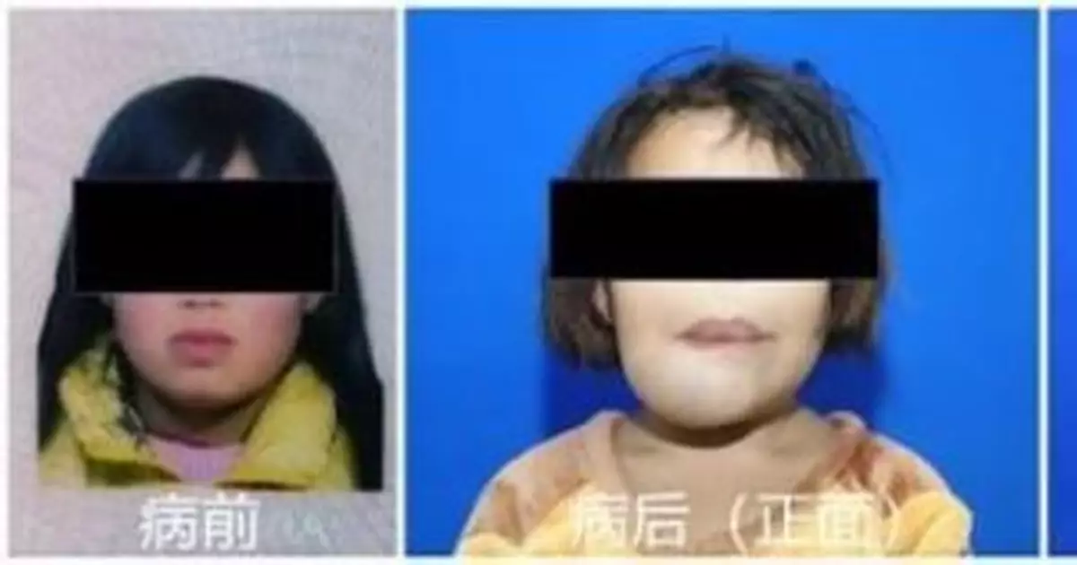 萌妹子居然有張「獅子臉」？ 原來是甲旁亢在作祟