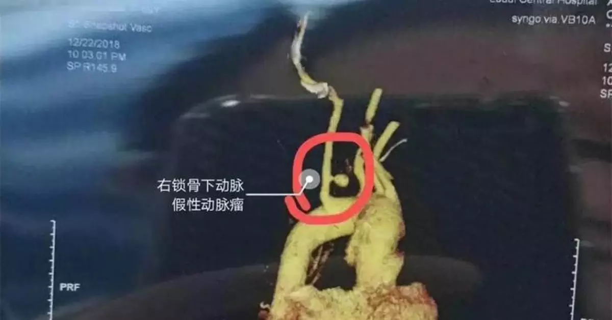 59歲大媽2次嘔掉全身的血險喪命 背後原因是它