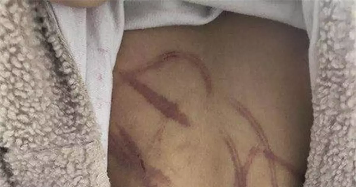 10歲女童疑遭父母家暴全身數十道血痕 官方已介入