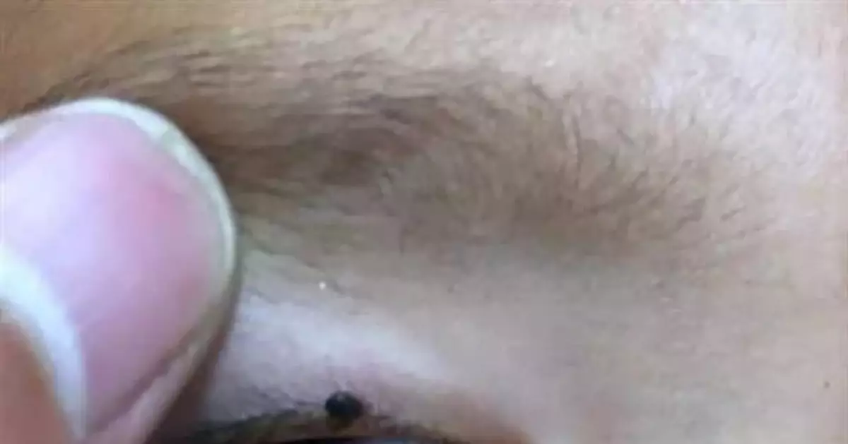 2歲娃眼皮上突然冒出小黑點 醫生：這東西會要命