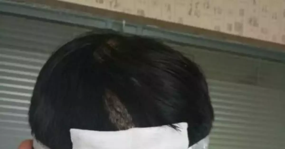 男子在飯店莫名失憶半分鐘 醒來摸頭滿手鮮血