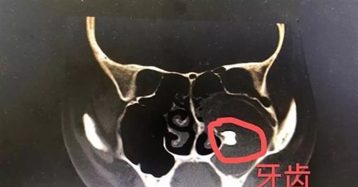 罕見！17歲女孩鼻腔里長了一顆牙齒