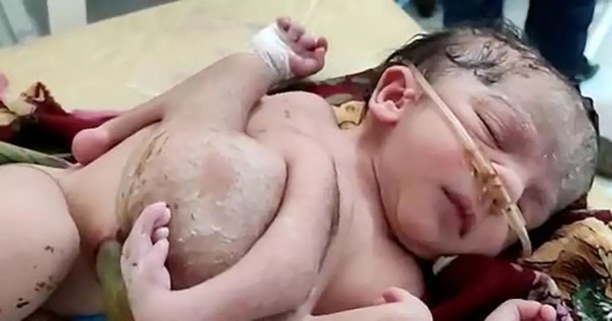 新生兒腹部長出兩條腿一隻手 或為三胞胎連體