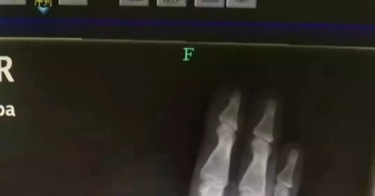 男子被蛇咬傷後自斷手指 醫生：其實沒必要…